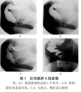 肛管直肠周围脓肿   