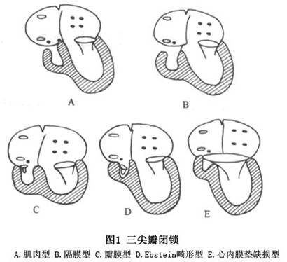 在三尖瓣闭锁的病例     三尖瓣闭锁的右心房与右心室连接类型有5种