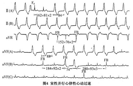 室性並行心律及室性並行心律性心動過速