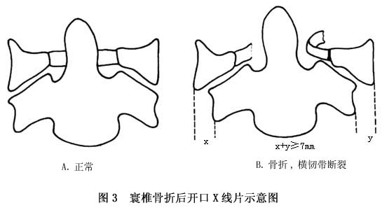 环椎骨折图片