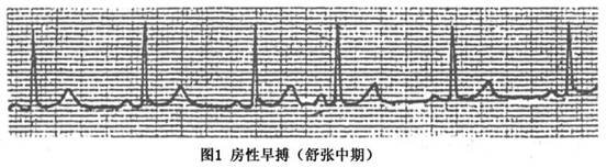 房性早搏