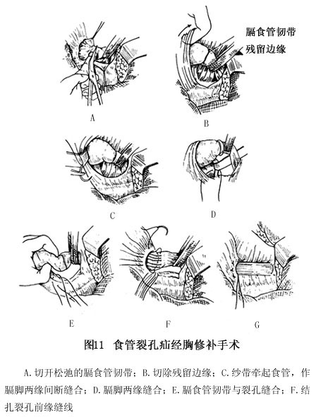 疝囊,去除多餘囊壁組織;充分顯露兩側膈肌腳並在食管後縫合固定2～3針