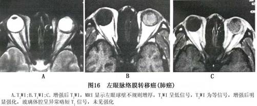 脉络膜黑色素瘤