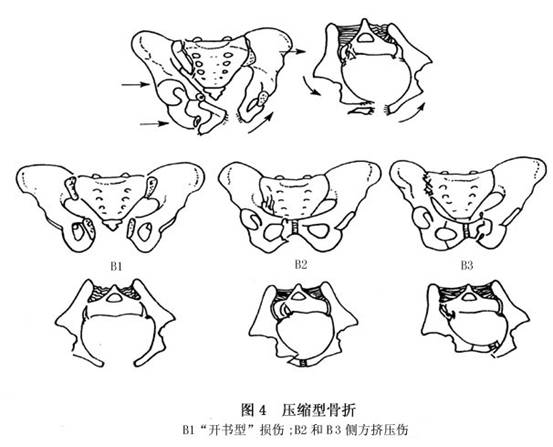 骨盆骨折