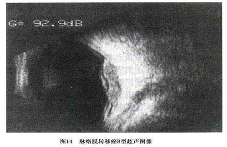 脉络膜黑色素瘤超声图片