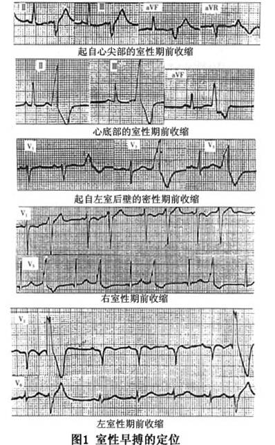 (2)右心室期前收缩:室性期前收缩qrs主波在Ⅰ,v5,v6导联向上,在v1