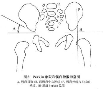 先天性髋关节脱位