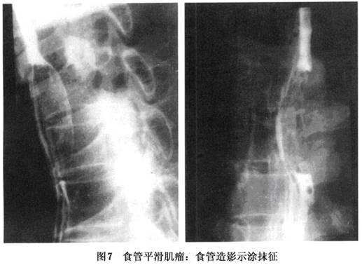 食管平滑肌瘤x线图片