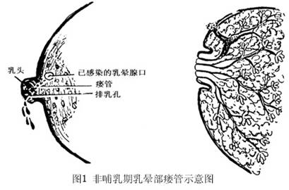 乳腺导管瘘的图片图片