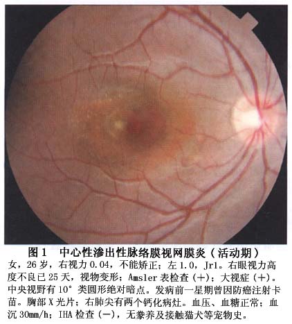 脉络膜透见图片