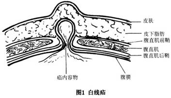 小孩白线疝图片图片