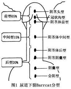 如果雄激素缺乏,尿生殖沟两侧皱褶的融合发生障碍,致使尿道腹侧壁缺损