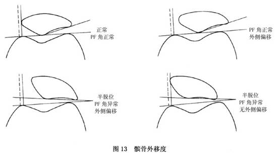 正常髌骨图片