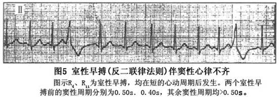 期前收缩心电图特点图片