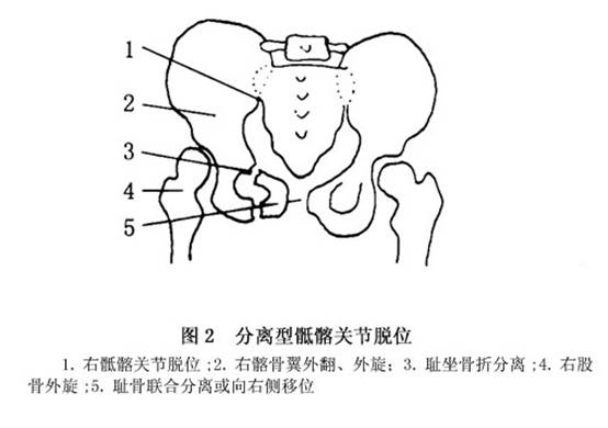 (2)依據骨盆環穩定性分類:前環骨折如恥骨支骨折,髂前上棘撕脫