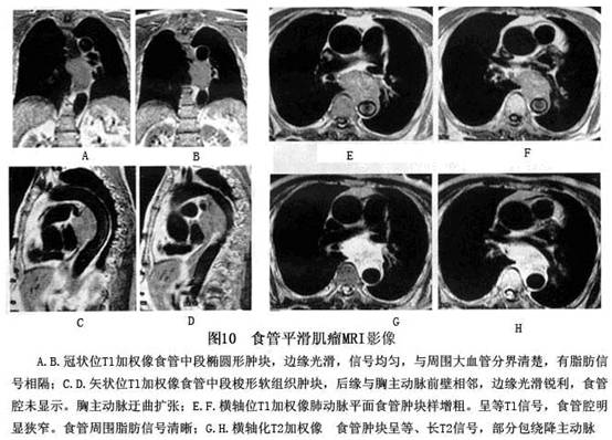 食管平滑肌瘤x线图片