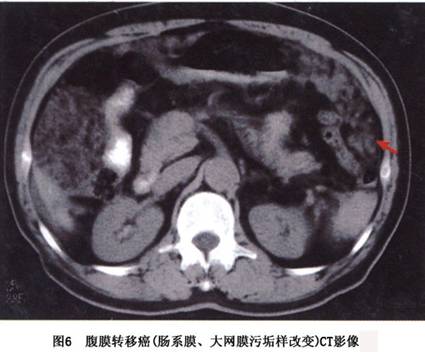 腹膜转移癌