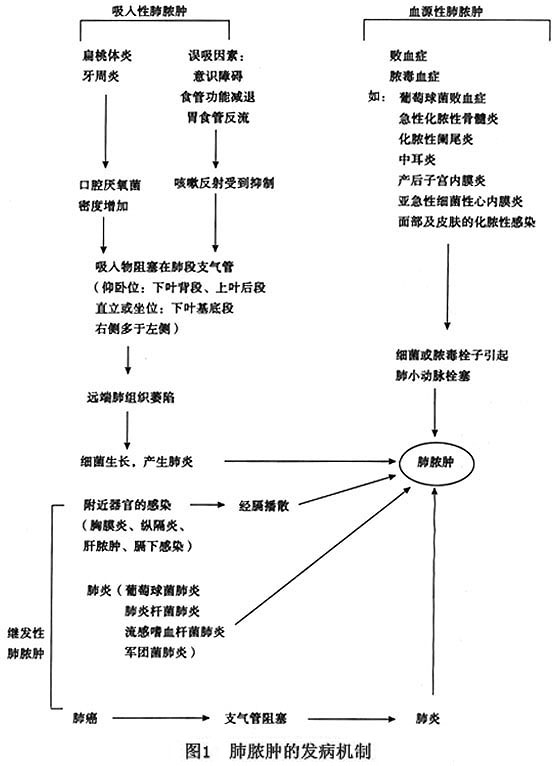 吸入性肺膿腫(aspiration lung abscess) 因口咽及鼻部的內容物吸入