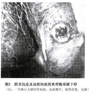 (1)一期梅毒:主要症狀為硬下疳(chancre),發生於不潔的性交後2～4