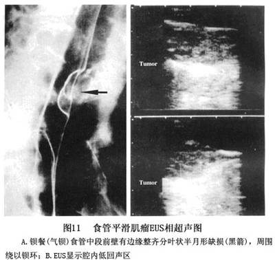 食管平滑肌瘤x线图片