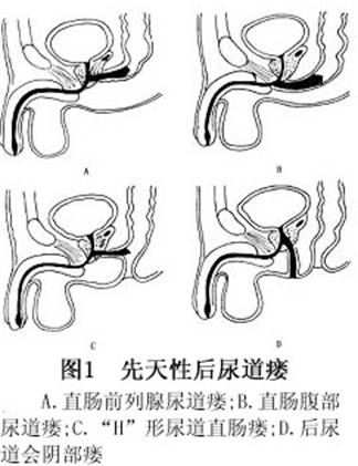 先天性后尿道瘘