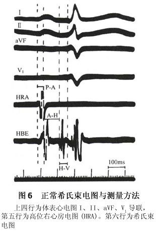 采用电极导管经静脉插入右心腔,直接接触房室束,记录其激动电波,即为