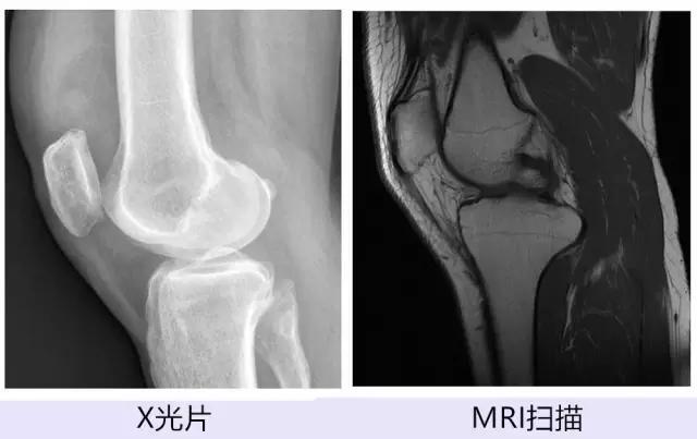 跑步膝和髌骨软化是一回事吗？得了髌骨软化怎么办？